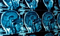 Η θεραπεία του καθρέφτη «ξυπνά» τους νευρώνες έπειτα από εγκεφαλικό